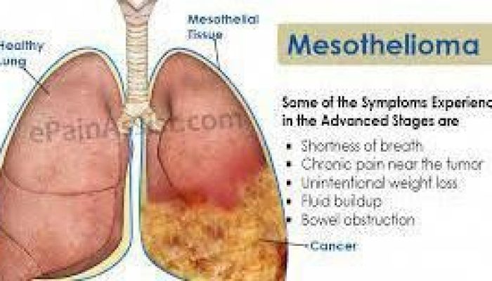 Mesothelioma Meaning In Medical Term