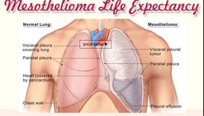 What Is The Life Expectancy Of Mesothelioma