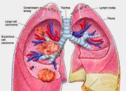 Mesothelioma Cancer In The Lungs