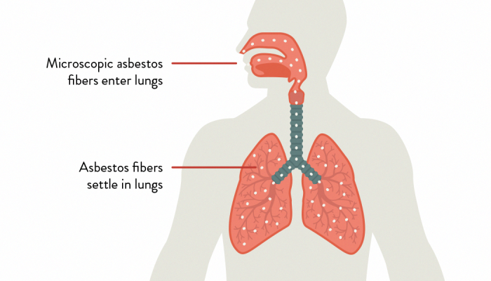 Which Type Of Asbestos Causes Mesothelioma