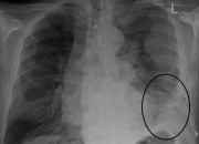 Can Mesothelioma Be Seen On An X Ray