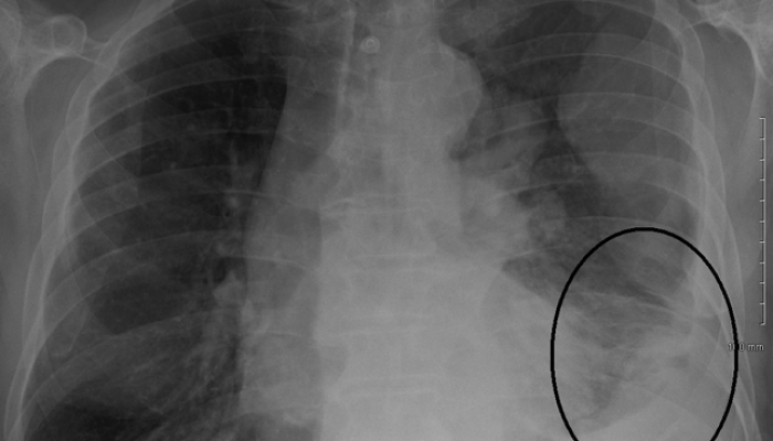 Can Mesothelioma Be Seen On An X Ray
