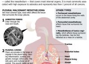 Treatment For Mesothelioma Lung Cancer