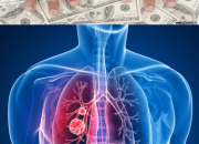 What Is The Compensation For Mesothelioma