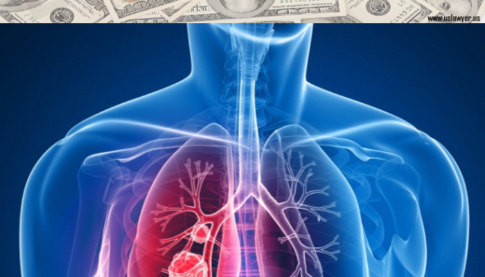 How To Claim Compensation For Mesothelioma