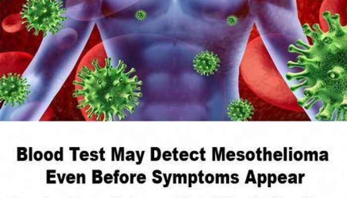 Can Blood Test Detect Mesothelioma
