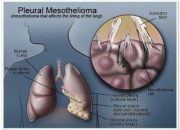 Mesothelioma Cancer What Is It