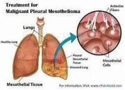 What Are The Symptoms Of Pleural Mesothelioma