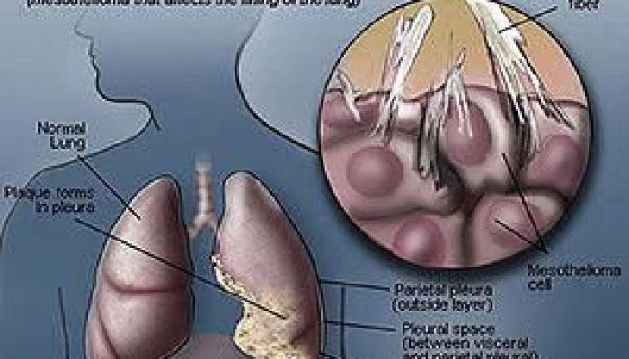 Mesothelioma Affects Which Body Organ