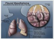 Asbestos Mesothelioma Of The Pleura