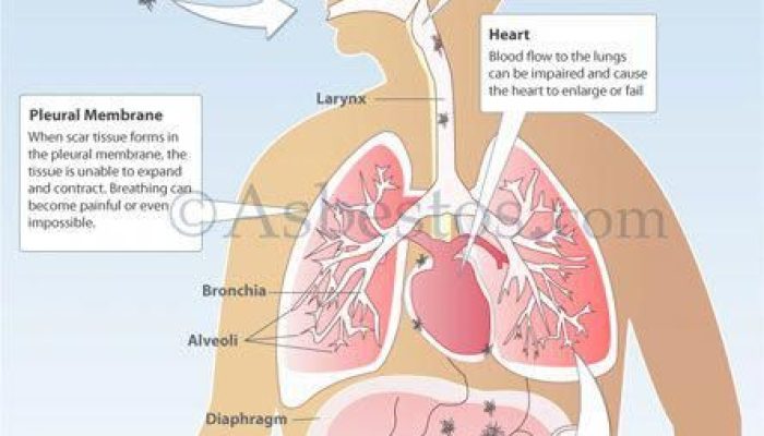 How Long Does Mesothelioma Take To Develop