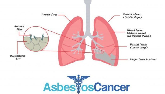 Mesothelioma How It Affects The Body
