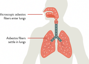 What Is Mesothelioma Cancer Caused From