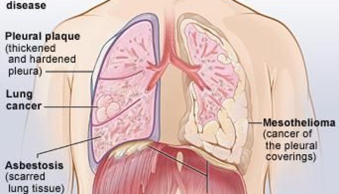 What Does Mesothelioma Look Like In The Lungs