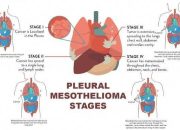 Mesothelioma Cancer That Has Spread
