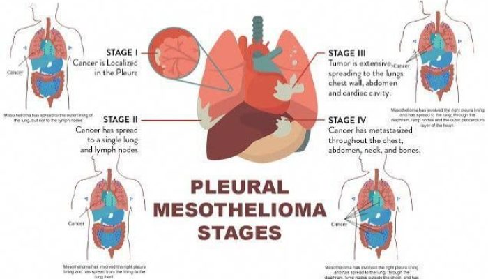Mesothelioma Cancer That Has Spread