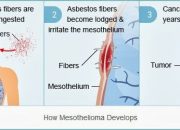 Malignant Mesothelioma Exposure To Asbestos