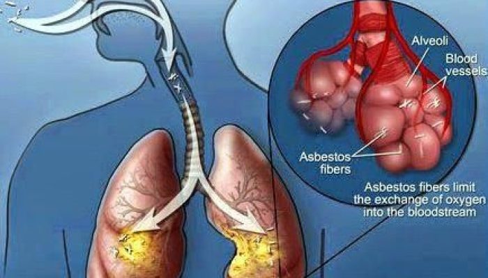 Mesothelioma Cancer Coughing Up Blood