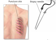 How To Prepare For A Lung Needle Biopsy