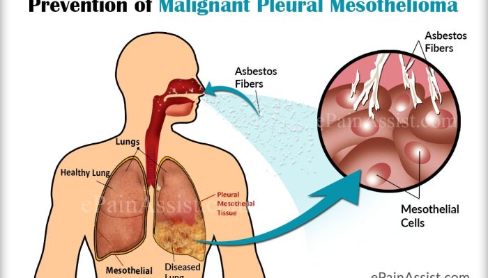 Does Mesothelioma Cause Pleural Effusion