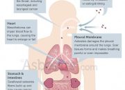 Mesothelioma Cancer Link Between Asbestos