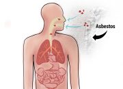 Peritoneal Mesothelioma Not Caused By Asbestos