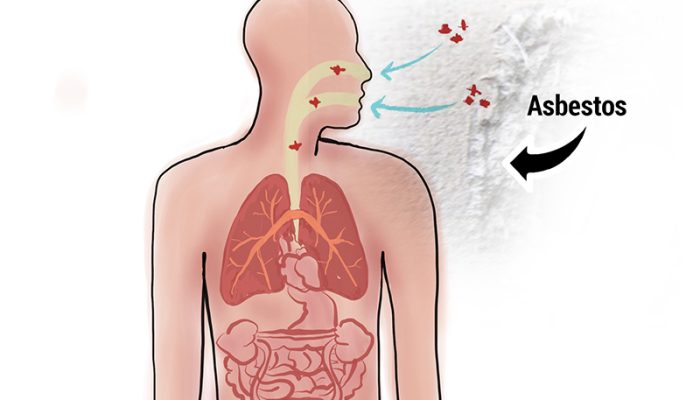 Peritoneal Mesothelioma Not Caused By Asbestos