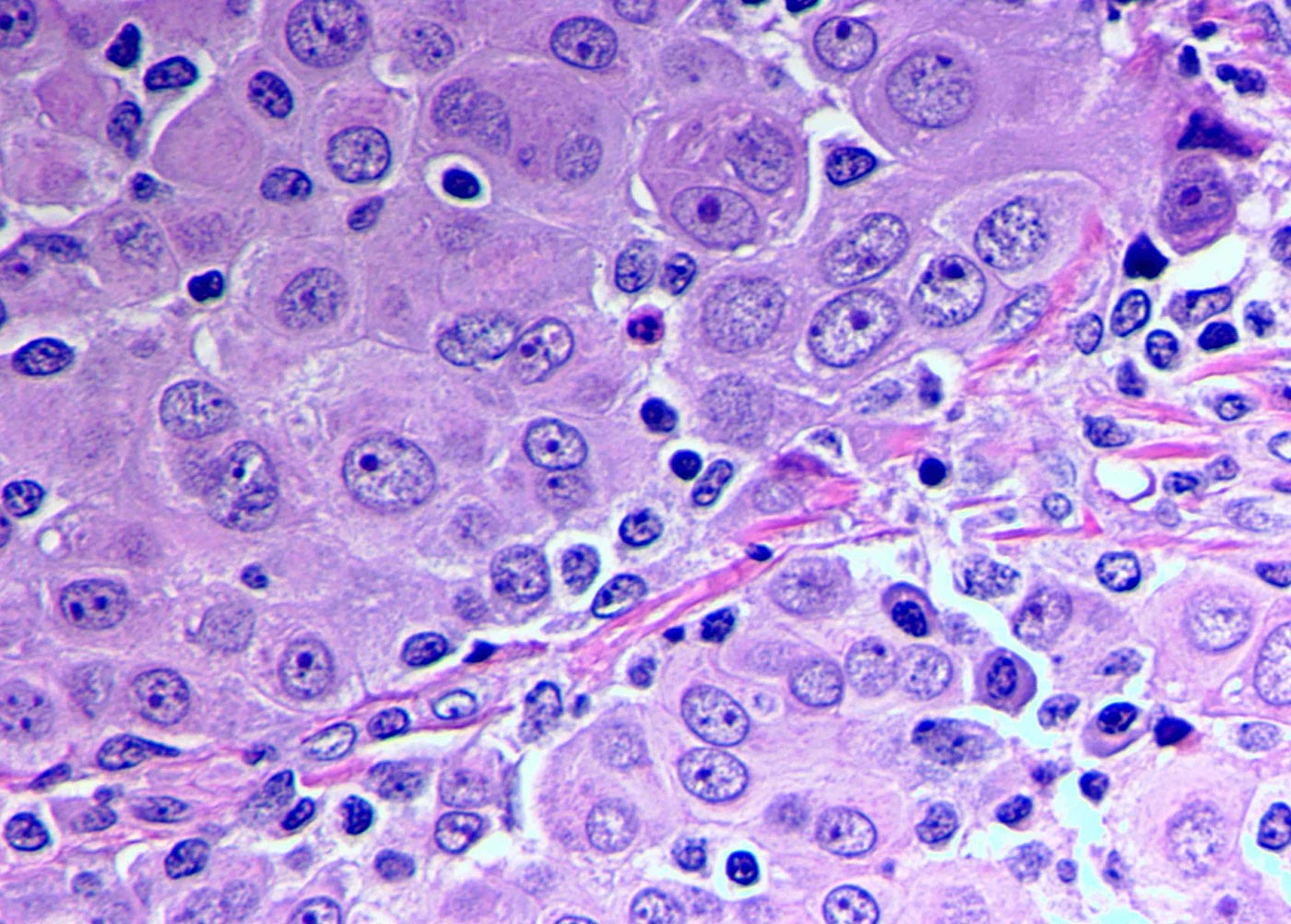 MESO epithelioid cells featured image 1