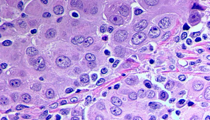 Epithelioid Mesothelioma And Squamous Carcinomas