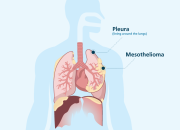 Mesothelioma Meaning In Medical Terminology