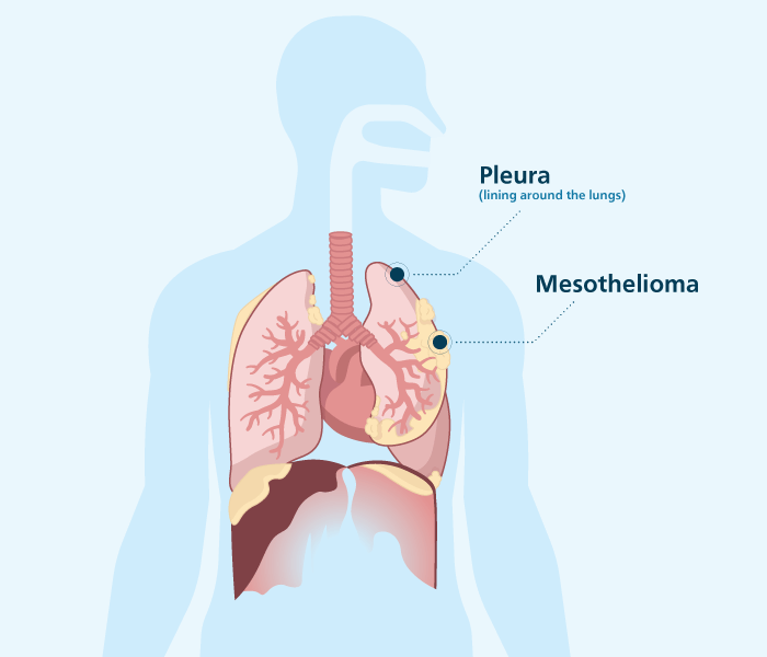 Mesothelioma of the Pleura