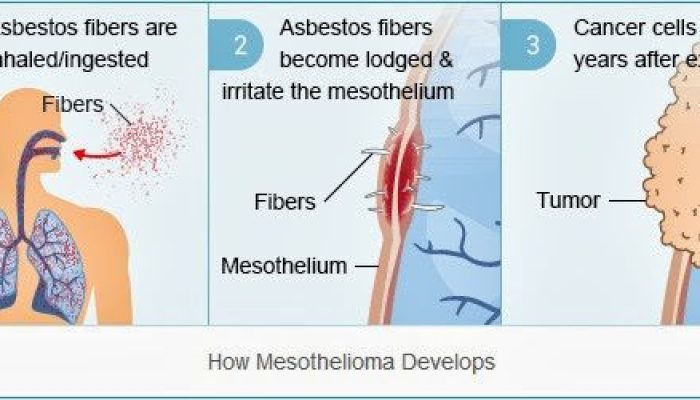 Risk Of Mesothelioma From Asbestos
