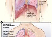 How Does Asbestosis Affect The Respiratory System