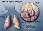 What Does Mesothelioma Do To The Lungs