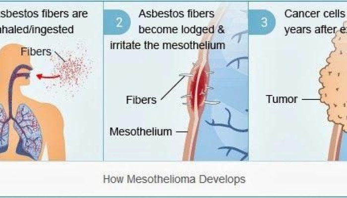 How Quickly Does Mesothelioma Develop