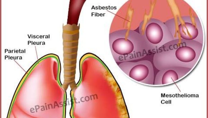 Definition Of Mesothelioma In Medical Terminology