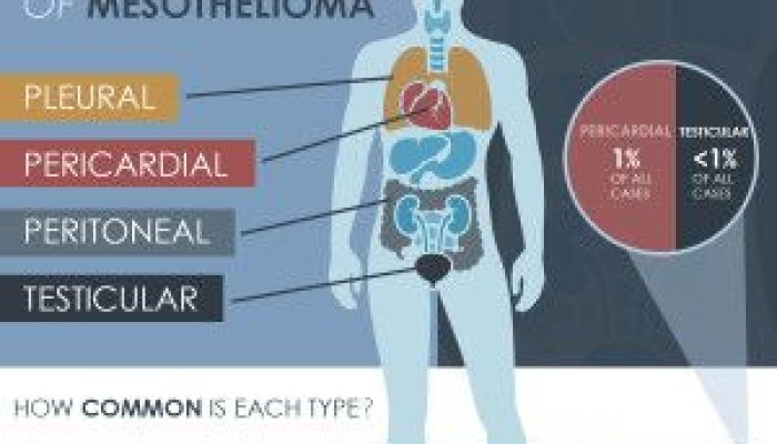 How Common Is Mesothelioma Cancer