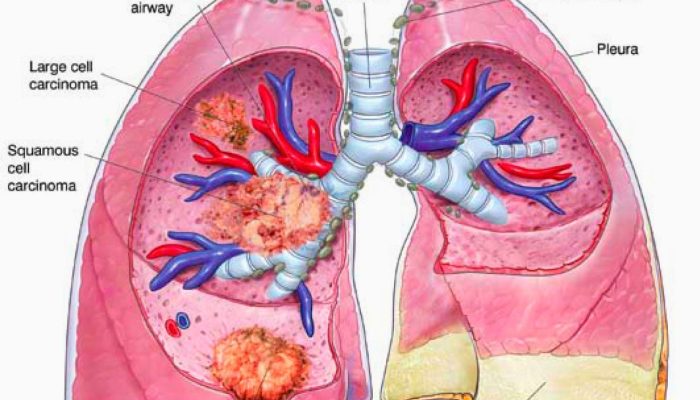 What Is The Difference Between Lung Cancer And Mesothelioma