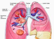 Asbestos Lung Cancer Vs Mesothelioma