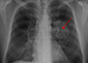 Does Mesothelioma Show On X Ray