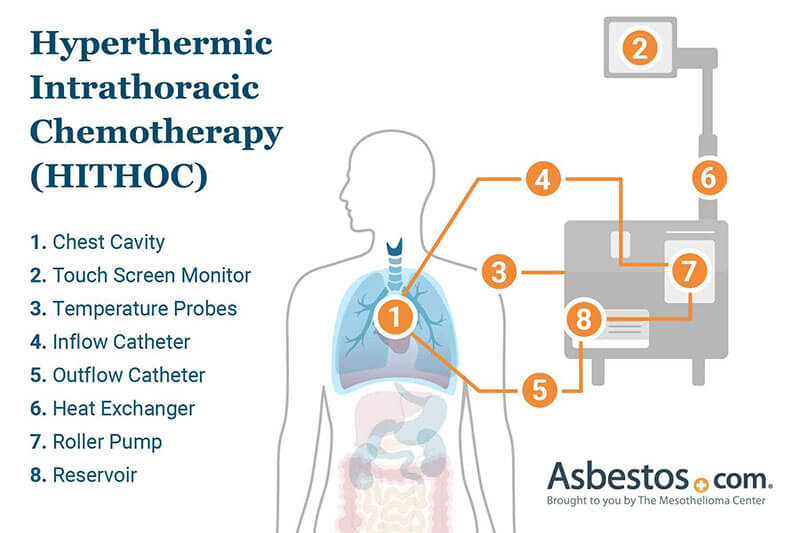hyperthermic intrathoracic chemotherapy hithoc 1