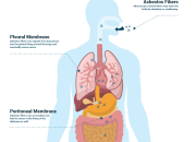 What Organs Does Mesothelioma Affect