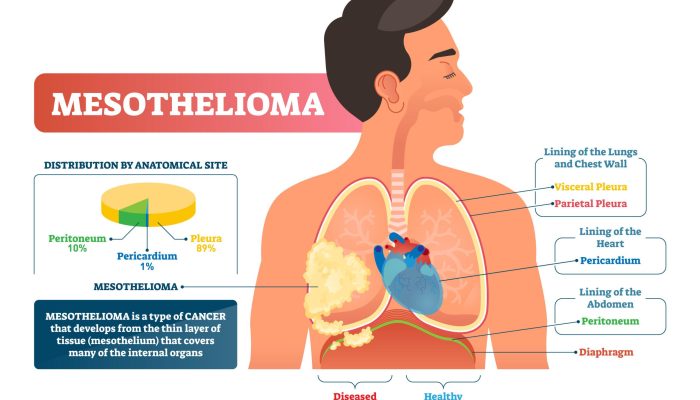 What Blood Test Shows Mesothelioma