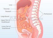 What Is Malignant Peritoneal Mesothelioma