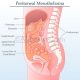 peritoneal mesothelioma diagram 1