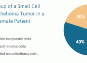 Is Mesothelioma A Small Cell Cancer