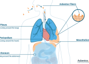 Malignant Mesothelioma Meaning In English