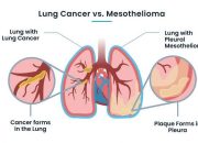 Mesothelioma And Lung Cancer Differences