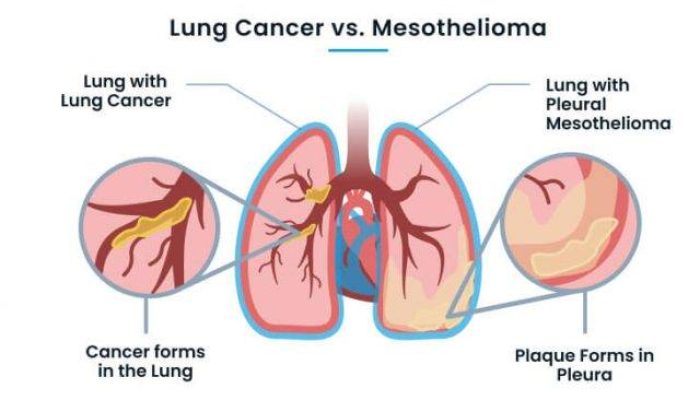 Mesothelioma And Lung Cancer Differences
